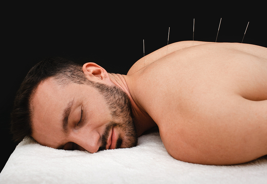 Male during acupuncture procedure. 